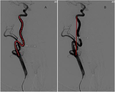 Extracranial Internal Carotid Artery Tortuosity and Body Mass Index